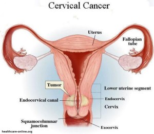 Cervical-Cancer